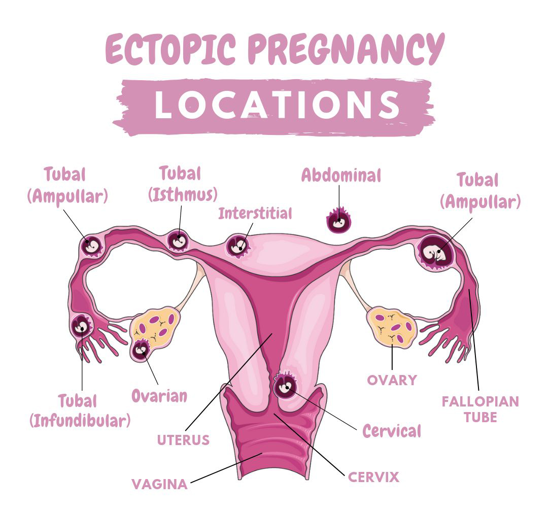 ectopic-gestation-pregnency-lancet-laparoscopy-center