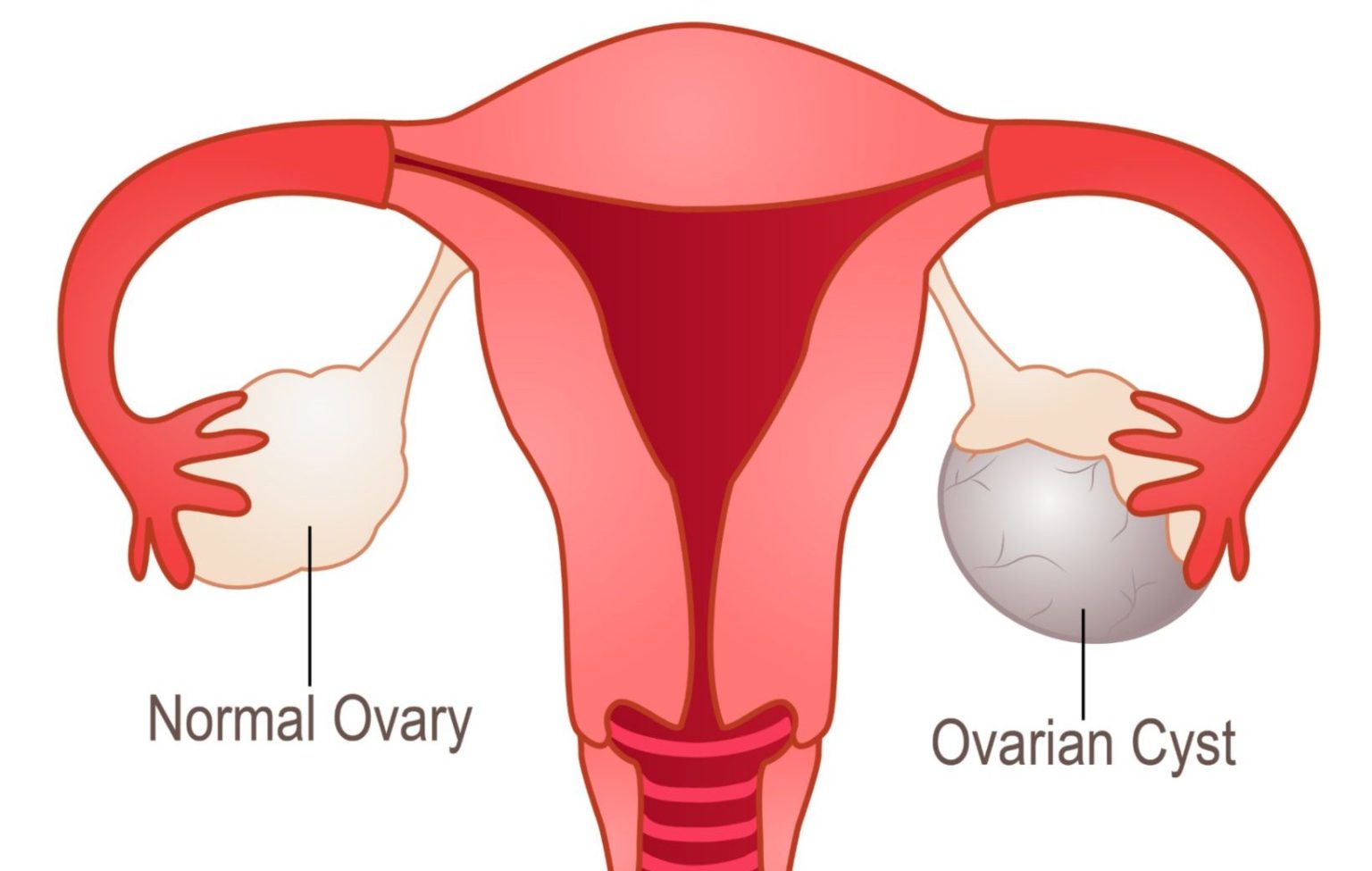 Laparoscopic Treatment For Ovarian Cysts Lancet Laparoscopy Center