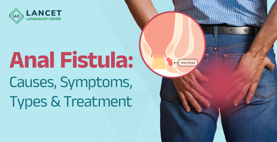 Learning About Fistula Surgery and Recovery