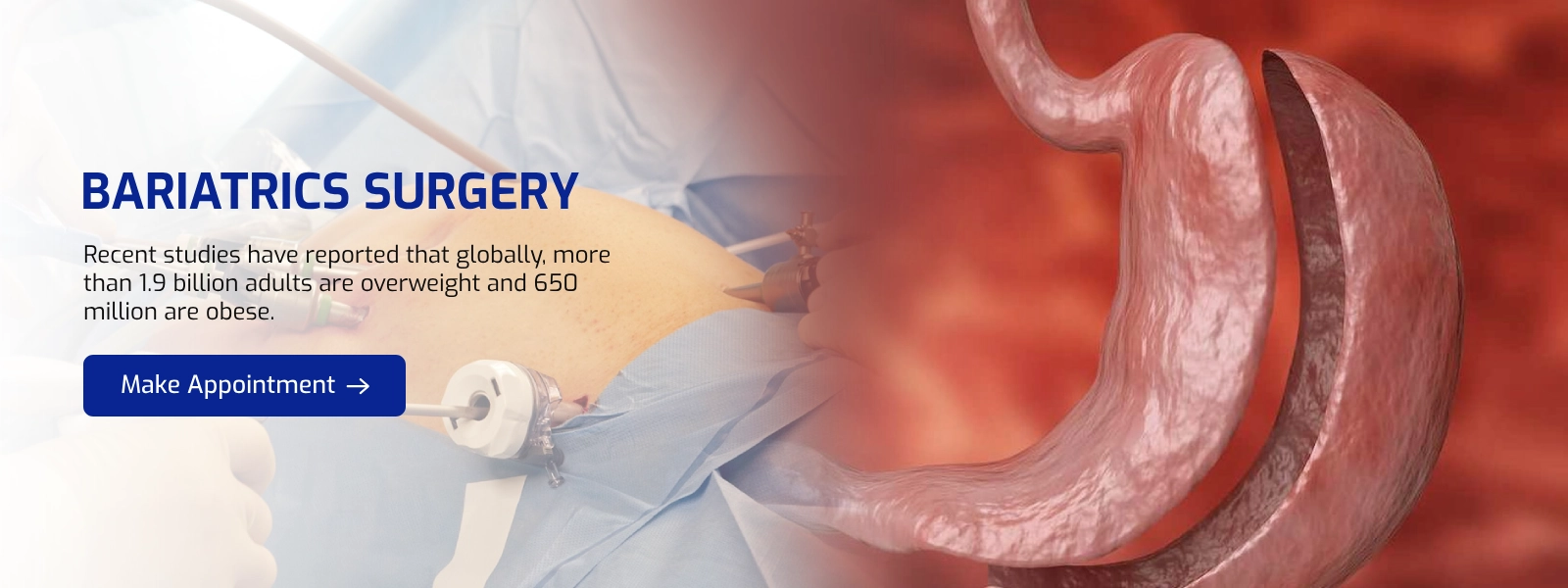 Best Bariatric Surgery for Obesity | Lancet Laparoscopy Center